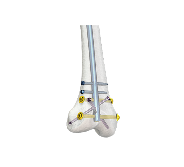 CHARFIX2 CONDYLAR RETROGRADE FEMORAL NAIL