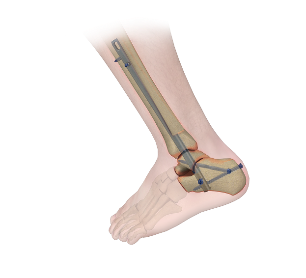 CHARFIX2 RETROGRADE TIBIA NAIL