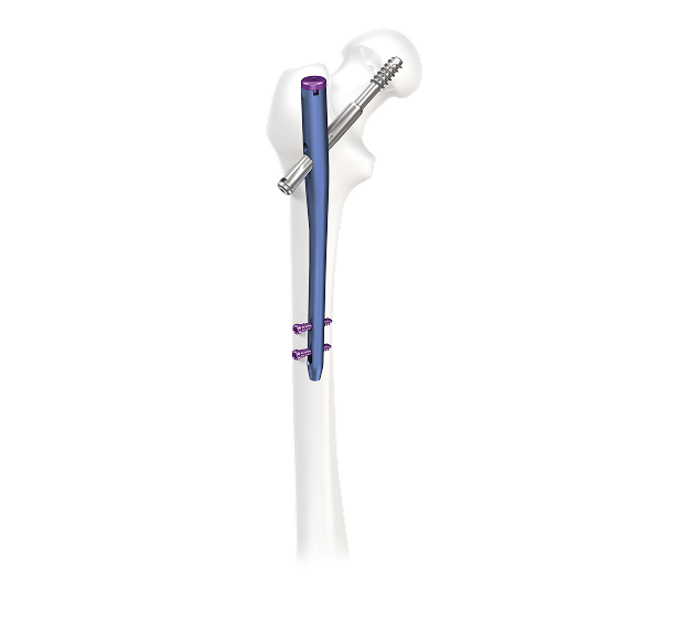 CHFN2 TROCHANTERIC NAIL